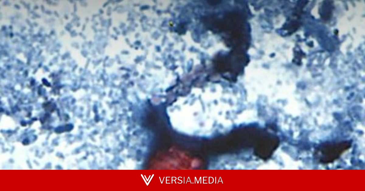 ألف إصابة بطفيلي غامض.. تفش غير مسبوق يقلق أميركا